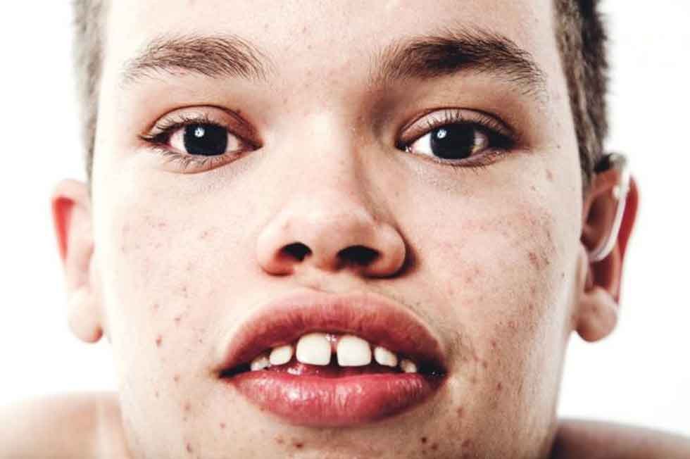 Diagnóstico temprano: el gran reto de la mucopolisacaridosis