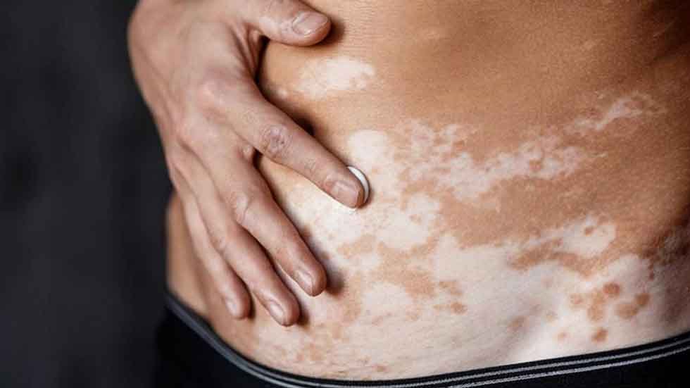 El vitiligo, una enfermedad cutánea que afecta más allá de la piel