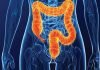 Cáncer colorrectal, la cuarta enfermedad más común en el mundo
