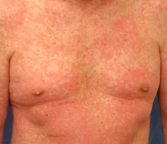 Secretaría de Salud del Distrito de Santa Marta descartó que “Casos de brote en la piel, no son por contaminación del mar”